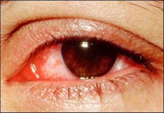 Cách phòng bệnh đau mắt đỏ