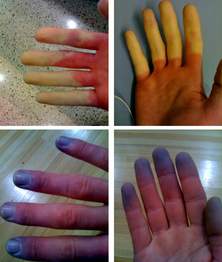Cứ lạnh là... đau - Bệnh gì?