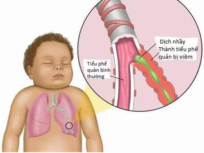 Bệnh viêm đường hô hấp cấp nặng do vi rút (Inflammatio viae respirationis gravis viruso)