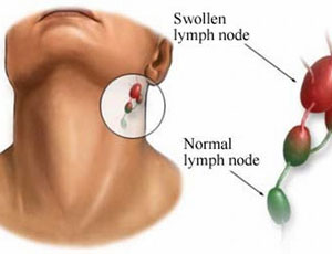 Bệnh bạch hầu (Diphteria)