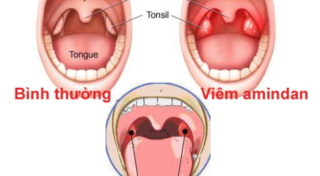 Khi nào nên cắt amiđan?